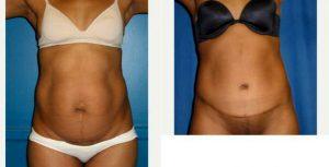 Dr Camille Cash, MD, Houston Plastic Surgeon - 36 Year Old Woman Treated With Tummy Tuck And Liposuction Of The Flanks.