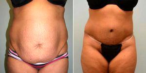 Dr Camille Cash, MD, Houston Plastic Surgeon - Tummy Tuck And Liposuction On 31 Year Old Mother Of 3