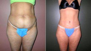 Dr Christopher J. Morea, MD, Raleigh-Durham Plastic Surgeon - Tummy Tuck With Flank Liposuction