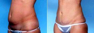 Dr Dan Mills, MD, Orange County Plastic Surgeon - 38 Year Old Female Treated With Abdominoplasty And Liposuction