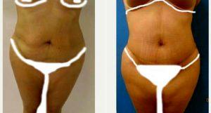 Dr Daniel Zeichner, MD, Plantation Plastic Surgeon - 31 Year Old Woman Treated With Tummy Tuck And Tickle Lipo Of Flanks