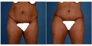 Dr David A. Sieber, MD, San Francisco General Surgeon - 33 Year Old Woman After Tummy Tuck And Liposuction Of Abdomen, Flanks, And Back