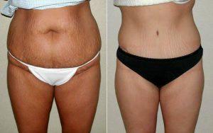 Dr Eric T. Emerson, MD, FACS, Charlotte Plastic Surgeon - Abdominoplasty, Extended, With Liposuction Of Flanks