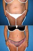 Dr Erik Miles, MD, FACS, Charlotte Plastic Surgeon - Extended Abdominoplasty With Liposuction Of Flanks
