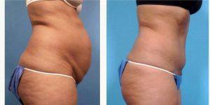 Dr Frank L. Stile, MD, Las Vegas Plastic Surgeon - 25 Year Old Woman Treated With Tummy Tuck