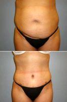 Dr Heather Rocheford, MD, Minneapolis Plastic Surgeon - 40 Y.O Woman, Full Abdominoplasty And Flank Liposuction.