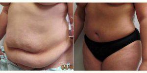 Dr J. Jason Wendel, MD, FACS, Nashville Plastic Surgeon - Tummy Tuck And Flank Liposuction For This 32 Year Old Woman