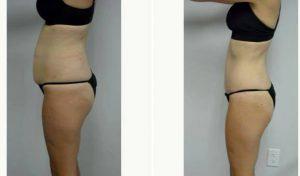 Dr Jonathan Hall, MD, Boston Plastic Surgeon - 36 Year Old Woman Treated With Tummy Tuck And Liposuction Of Her Flanks And Lower Back