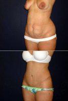Dr Kelly Gallego, MD, FACS, Yuba City Plastic Surgeon - Abdominoplasty With Liposuction Of Flanks