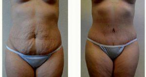 Dr Kelly R. Kunkel, MD, Fort Worth Plastic Surgeon - Tummy Tuck (Abdominoplasty) And Flank Liposuction In A 40 Year-old Woman