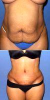 Dr Naveen Setty, MD, Dallas Plastic Surgeon - 35 Year Old 6 Weeks After Tummy Tuck And Lipo Flanks