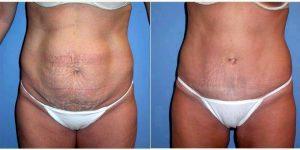 Dr Philip Lambruschi, MD, Arlington Heights Plastic Surgeon - 36 Year Old Woman Treated With Tummy Tuck Abdominoplasty With Flank Liposuction