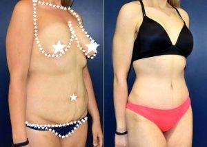 Dr Richard G. Reish, MD, New York Plastic Surgeon - 22 Year Old Woman Treated With Tummy Tuck For Stretch Marks