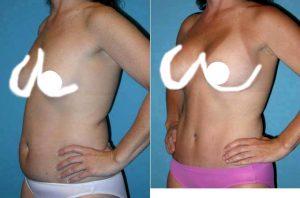 Dr Sam Jejurikar, MD, Dallas Plastic Surgeon - Abdominoplasty With Flank Liposuction, Breast Augmentation