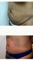 Dr. Alexander Golger, MD, Toronto Plastic Surgeon - 36 Year Old Woman Treated With Tummy Tuck