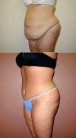 Dr. Christopher J. Morea, MD, Raleigh-Durham Plastic Surgeon - Tummy Tuck With Flank Liposuction