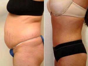 Dr. Franklin D. Richards, MD, Bethesda Plastic Surgeon - Abdominoplasty (Tummy-Tuck) And Liposuction Of Flanks
