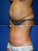 Dr. Glynn Bolitho, PhD, MD, FACS, San Diego Plastic Surgeon - 42 Year Old Female Before After Full Abdominoplasty With Liposuction Of The Abdomen Flanks Before