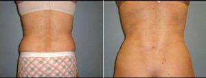 Dr. Heather Rocheford, MD, Minneapolis Plastic Surgeon - 50 Year Old Woman Treated For Tummy Tuck And Flank Liposuction.