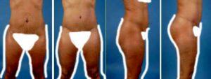 Dr. Jeffrey Kenkel, MD, Dallas Plastic Surgeon - Extended Bilateral Tummy Tuck Lipo To Flanks