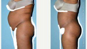 Dr. Jose Perez-Gurri, MD, FACS, Miami Plastic Surgeon - 35 Year Old Woman Treated With Tummy Tuck - Liposuction Of Hips And Flanks (PAL)