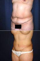 Dr. Kelly Gallego, MD, FACS, Yuba City Plastic Surgeon - Abdominoplasty With Liposuction Of Flanks