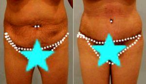 Dr. Laura Carmina Cardenas, MD, Mexico Plastic Surgeon - Extended Tummy Tuck For Stretch Marks