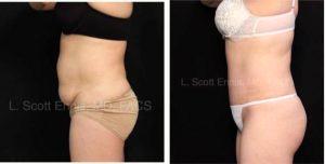 Dr. Lawrence Scott Ennis, MD, FACS, Pensacola Plastic Surgeon - 40 Year Old Female With Abdominoplasty