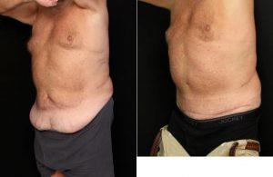 Dr. Lawrence Scott Ennis, MD, FACS, Pensacola Plastic Surgeon - 59 Year Old Male With Abdominoplasty (tummy Tuck)