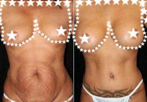 Dr. Mary Lee Peters, MD, Seattle Plastic Surgeon - Tummy Tuck For Stretch Marks And Breast Augmentation