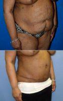 Dr. Matthew G. Stanwix, MD, FACS, Richmond Plastic Surgeon - Tummy Tuck With Liposuction Flanks