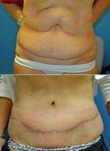 Dr. Melissa Johnson, MD, Springfield Plastic Surgeon - 53 Year Old Woman Treated With Tummy Tuck For Stretch Marks