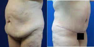 Dr. Michael A. Fallucco, MD, FACS, Jacksonville Plastic Surgeon - 60 Year Old Woman Treated With Tummy Tuck And Liposuction Abdomen And Flanks