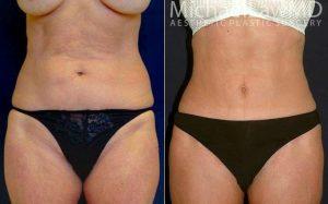 Dr. Michael Law, MD, Raleigh-Durham Plastic Surgeon - 53 Year Old Woman Treated With Tummy Tuck For Stretch Marks