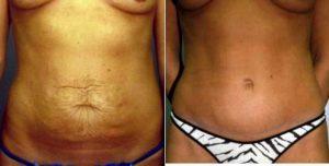 Dr. Neal Handel, MD, Beverly Hills Plastic Surgeon - Mommy Makeover (Tummy Tuck For Stretch Marks And Conservative Breast Augmentation)
