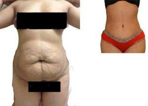Dr. Norman G. Morrison, MD, FACS, New York Plastic Surgeon - 3 Month Post Operative Tummy Tuck For Stretch Marks
