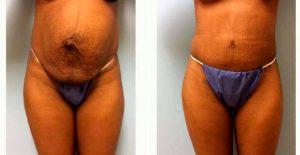 Dr. Paul S. Gill, MD, Houston Plastic Surgeon - 31 Year Old Woman Treated With Tummy Tuck And Lipo To Flanks