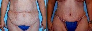 Dr. Paul S. Gill, MD, Houston Plastic Surgeon - Tummy Tuck For Stretch Marks With Extensive Liposuction