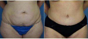 Dr. Raj S. Ambay, MD, Tampa Plastic Surgeon - 24 Year Old Woman Treated With Tummy Tuck For Stretch Marks
