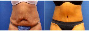 Dr. Raymond Jean, MD, Philadelphia Plastic Surgeon - 51 Year Old Woman Treated With Tummy Tuck For Stretch Marks