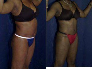 Dr. Ricardo L. Rodriguez, MD, Baltimore Plastic Surgeon - Abdominoplasty And Liposuction To Flanks