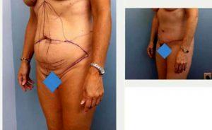 Dr. Richard J. Wassermann, MD, MPH, Columbia Plastic Surgeon - 46 Year Old Woman Treated With Tummy Tuck For Stretch Marks