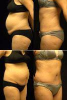 Dr. Robert M. Lowen, MD, Mountain View Plastic Surgeon - 40 Year Old Woman 3 Months After Abdominoplasty And Vaser Assisted Lipoplasty Of The Waist And Flanks