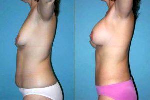 Dr. Sam Jejurikar, MD, Dallas Plastic Surgeon - Abdominoplasty With Flank Liposuction, Breast Augmentation