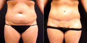 Dr. Stephen E. Zucker, MD, South Bend Plastic Surgeon - 44 Year Old Woman Treated With Tummy Tuck And SAFELipo Of Flanks And Back Rolls