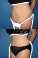 Extended Abdominoplasty With Liposuction Of Flanks By Dr. Erik Miles, MD, FACS, Charlotte Plastic Surgeon