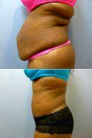 Full Tummy Tuck And Liposuction Of Flanks, Waist And Bra Area By Dr Amy T. Bandy, DO, FACS, Newport Beach Plastic Surgeon