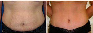 Removal Of Excess Skin And Diminished Appearance Of Stretch Marks After Weight Loss Before With Dr Camille Cash, MD, Houston Plastic Surgeon