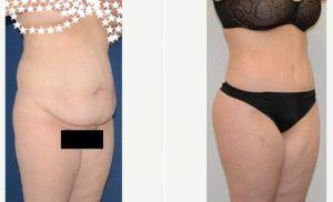 Stretched Muscles, Loose Skin Treated With Tummy Tuck - Circumferential Liposculpture With Dr Peter Bray, MD, Toronto Plastic Surgeon
