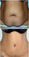 Tummy Tuck Abdominoplasty With Liposuction Of Flanks And Back By Dr Anire Okpaku, MD FACS, Miami Plastic Surgeon